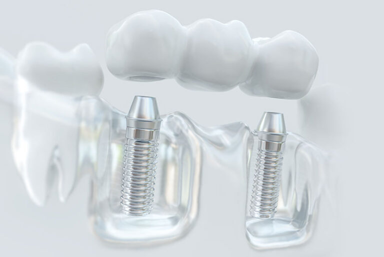 Multi implant bridge