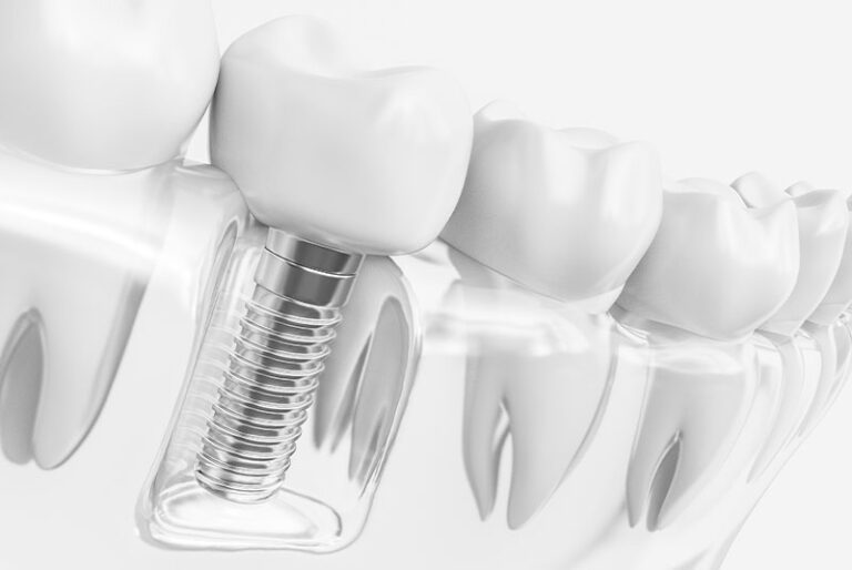 Single dental implant